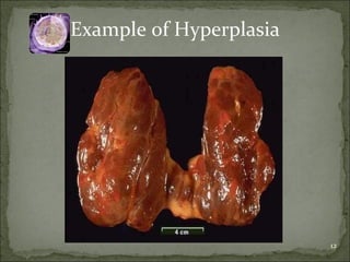 Example of Hyperplasia 