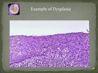 Example of Dysplasia 