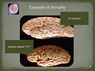 Example of Atrophy I’m Normal ! Atrophy Attack!:???? 