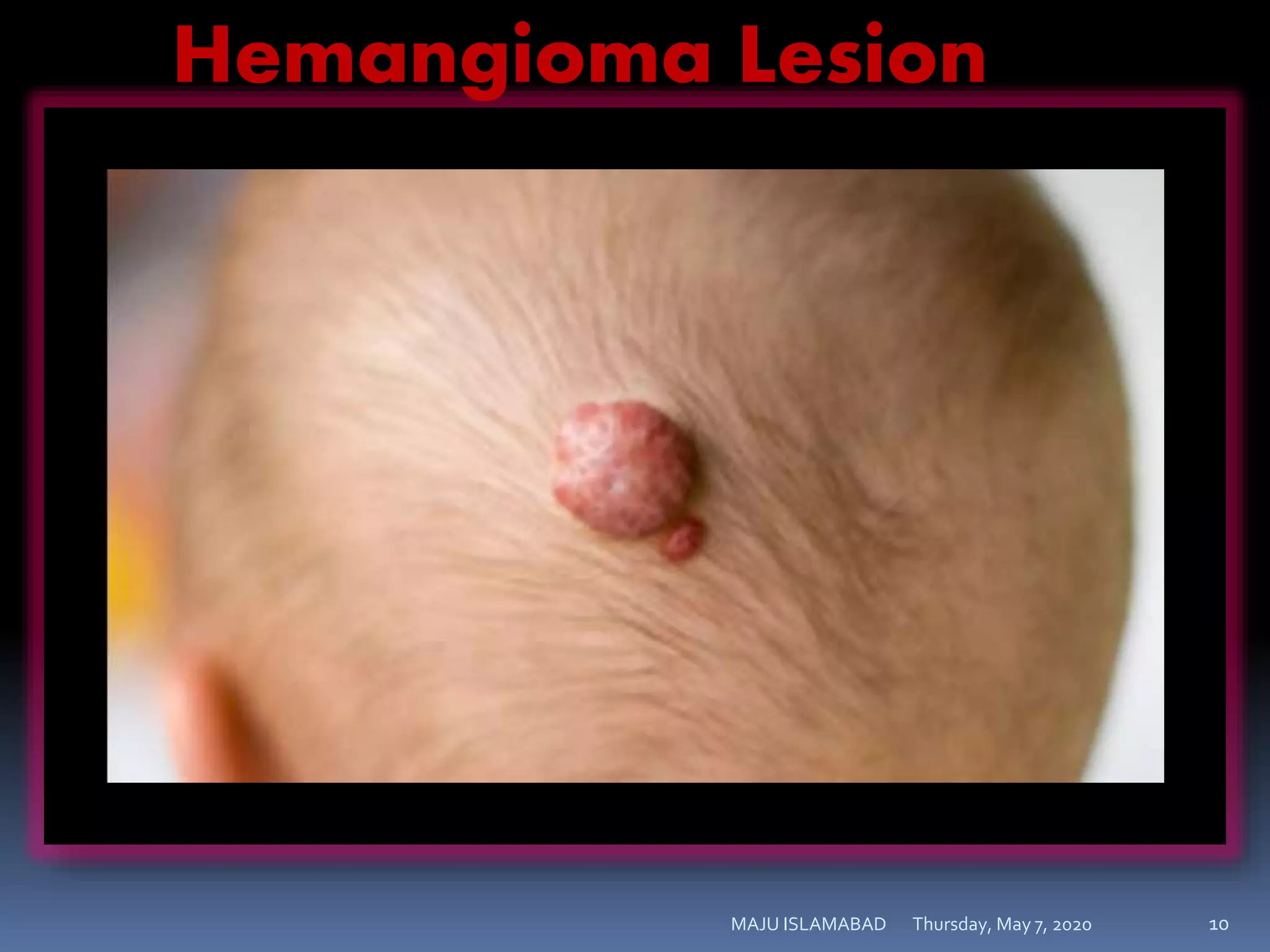 Thursday, May 7, 2020MAJU ISLAMABAD 10
Hemangioma Lesion
 