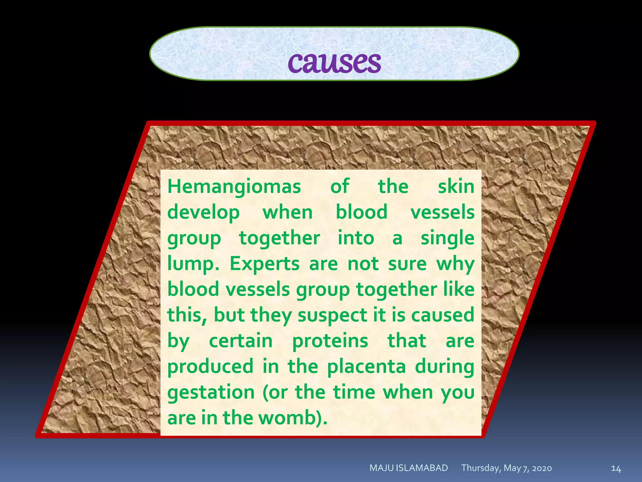 Thursday, May 7, 2020MAJU ISLAMABAD 14
causes
Hemangiomas of the skin
develop when blood vessels
group together into a single
lump. Experts are not sure why
blood vessels group together like
this, but they suspect it is caused
by certain proteins that are
produced in the placenta during
gestation (or the time when you
are in the womb).
 