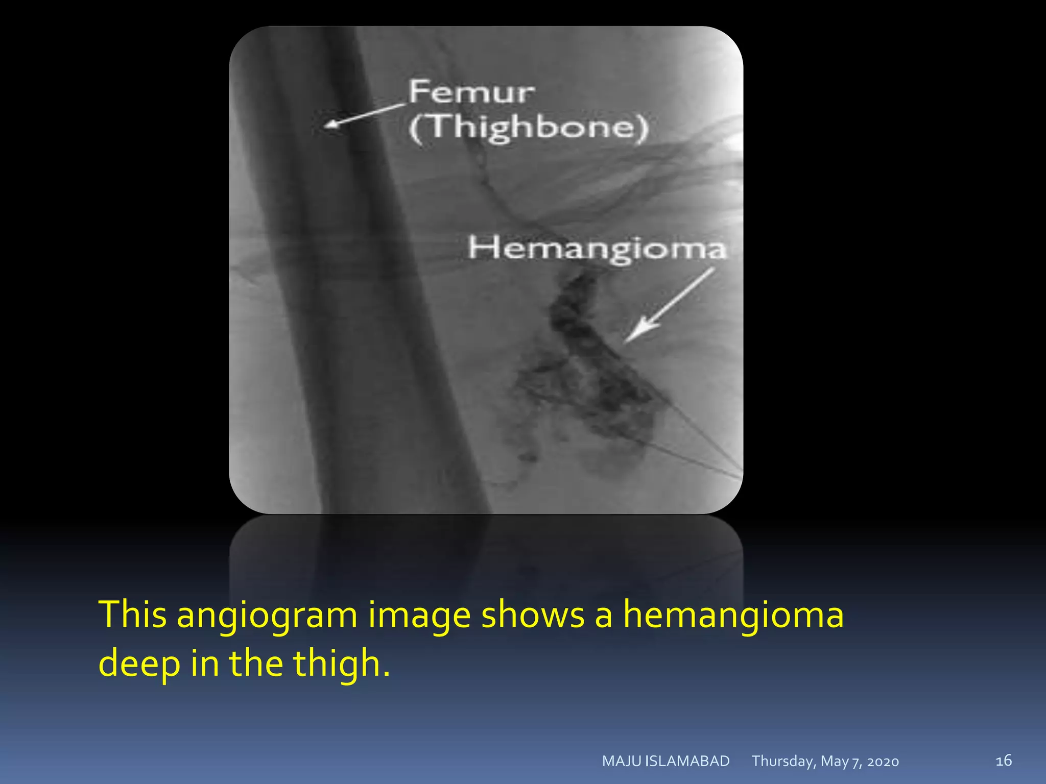 Thursday, May 7, 2020MAJU ISLAMABAD 16
This angiogram image shows a hemangioma
deep in the thigh.
 