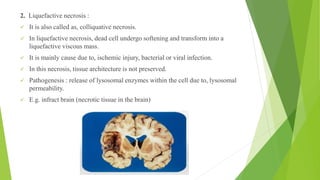 2. Liquefactive necrosis :
✓ It is also called as, colliquative necrosis.
✓ In liquefactive necrosis, dead cell undergo softening and transform into a
liquefactive viscous mass.
✓ It is mainly cause due to, ischemic injury, bacterial or viral infection.
✓ In this necrosis, tissue architecture is not preserved.
✓ Pathogenesis : release of lysosomal enzymes within the cell due to, lysosomal
permeability.
✓ E.g. infract brain (necrotic tissue in the brain)
 