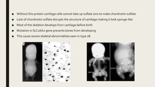 ■ Without this protein cartilage cells cannot take up sulfate ions to make chondroitin sulfate
■ Lack of chondroitin sulfate disrupts the structure of cartilage making it look sponge-like
■ Most of the skeleton develops from cartilage before birth
■ Mutation in SLC26A2 gene prevents bones from developing
■ This cause severe skeletal abnormalities seen in type 1B
 