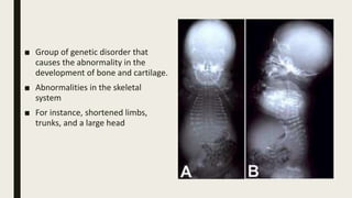 ■ Group of genetic disorder that
causes the abnormality in the
development of bone and cartilage.
■ Abnormalities in the skeletal
system
■ For instance, shortened limbs,
trunks, and a large head
 