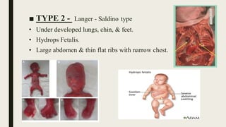 ■ TYPE 2 - Langer - Saldino type
• Under developed lungs, chin, & feet.
• Hydrops Fetalis.
• Large abdomen & thin flat ribs with narrow chest.
 