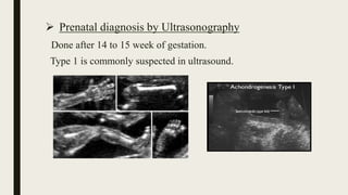  Prenatal diagnosis by Ultrasonography
Done after 14 to 15 week of gestation.
Type 1 is commonly suspected in ultrasound.
 