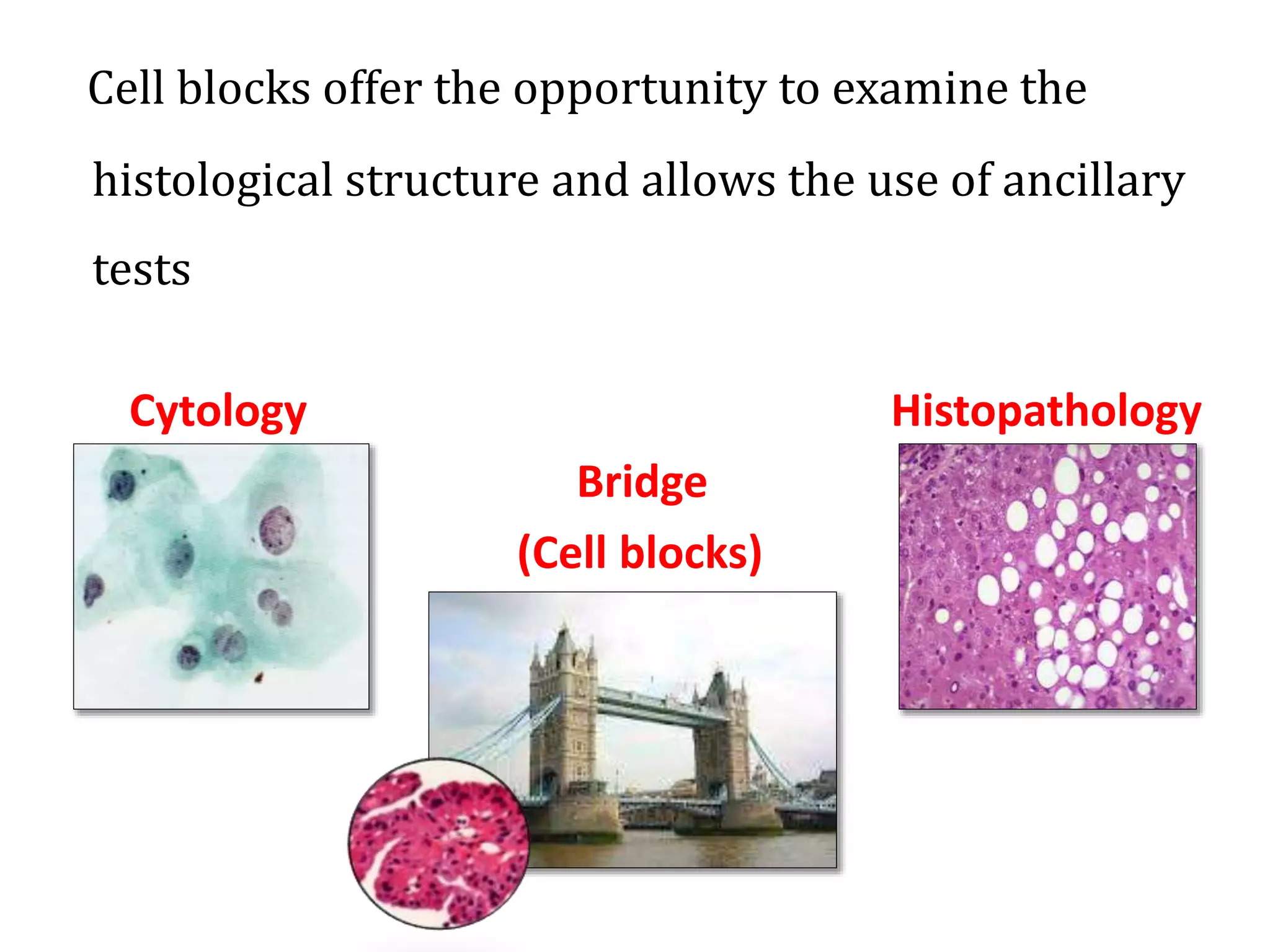 Cell blocks offer the opportunity to examine the
histological structure and allows the use of ancillary
tests
Cytology Histopathology
Bridge
(Cell blocks)
 
