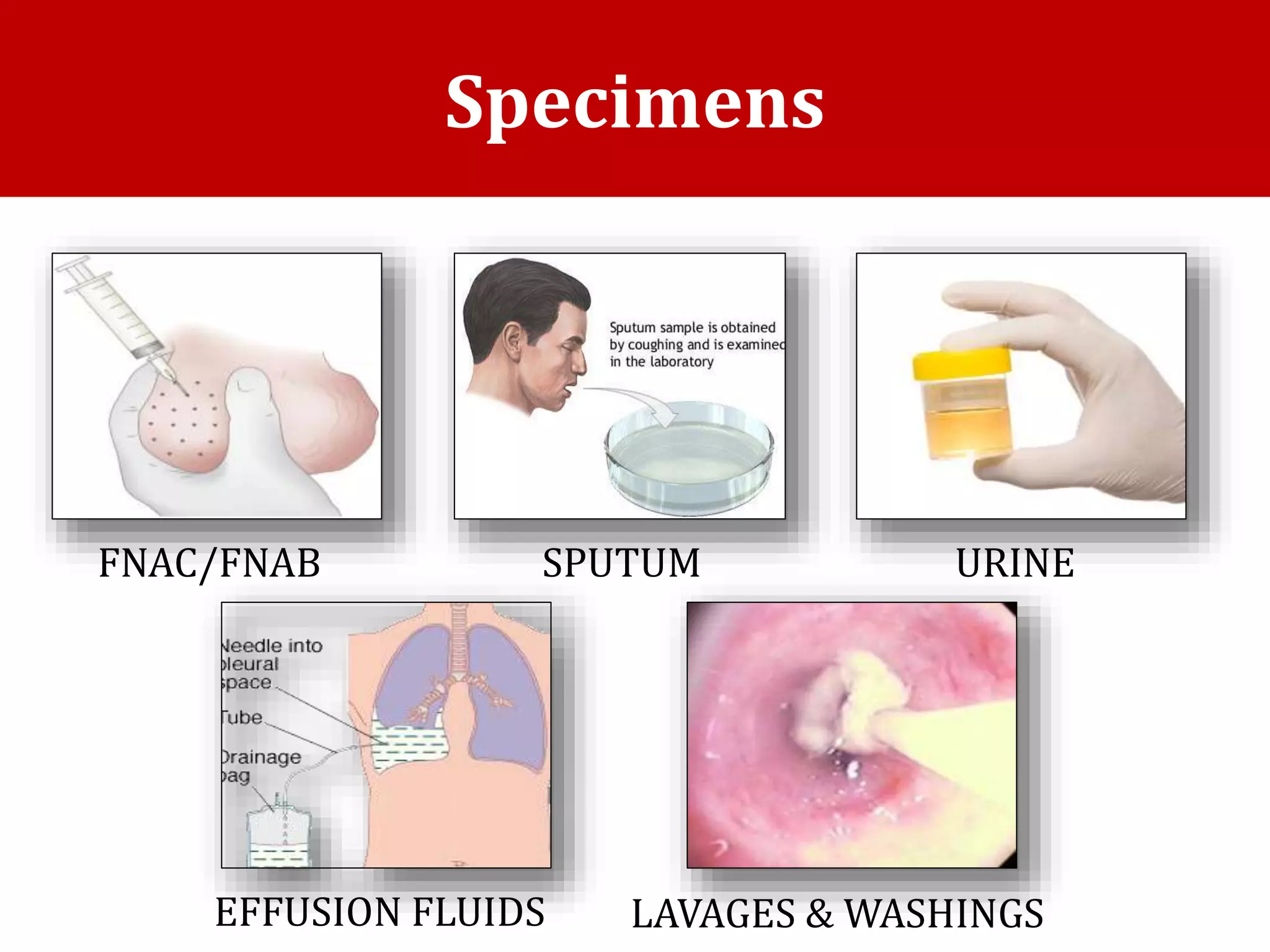 Specimens
FNAC/FNAB SPUTUM
EFFUSION FLUIDS
URINE
LAVAGES & WASHINGS
 