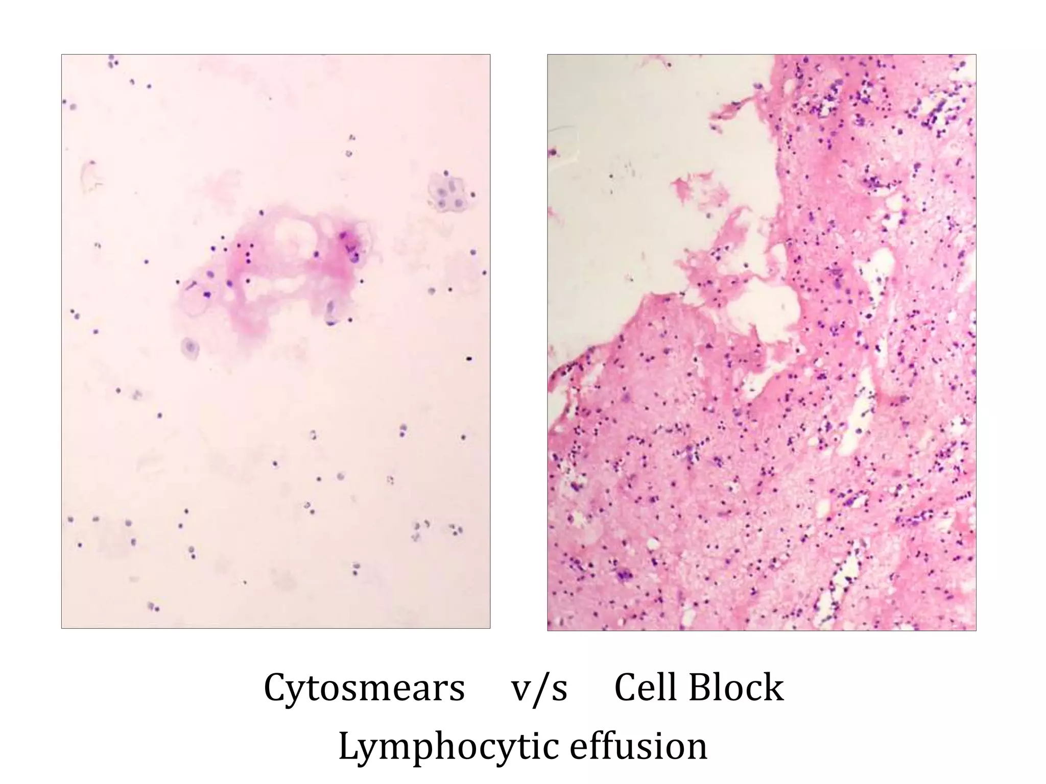 Cytosmears v/s Cell Block
Lymphocytic effusion
 
