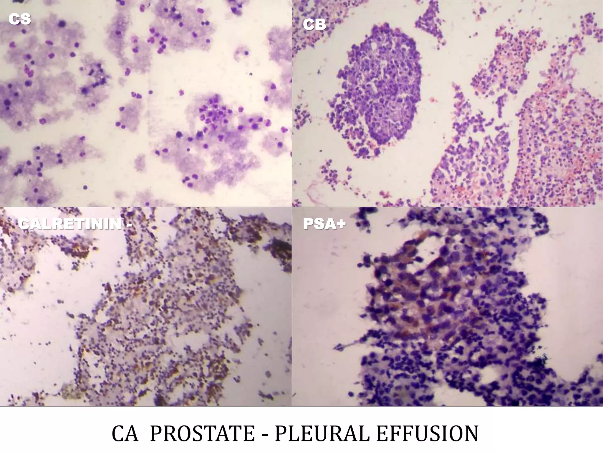 CA PROSTATE - PLEURAL EFFUSION
CS CB
CALRETININ - PSA+
 