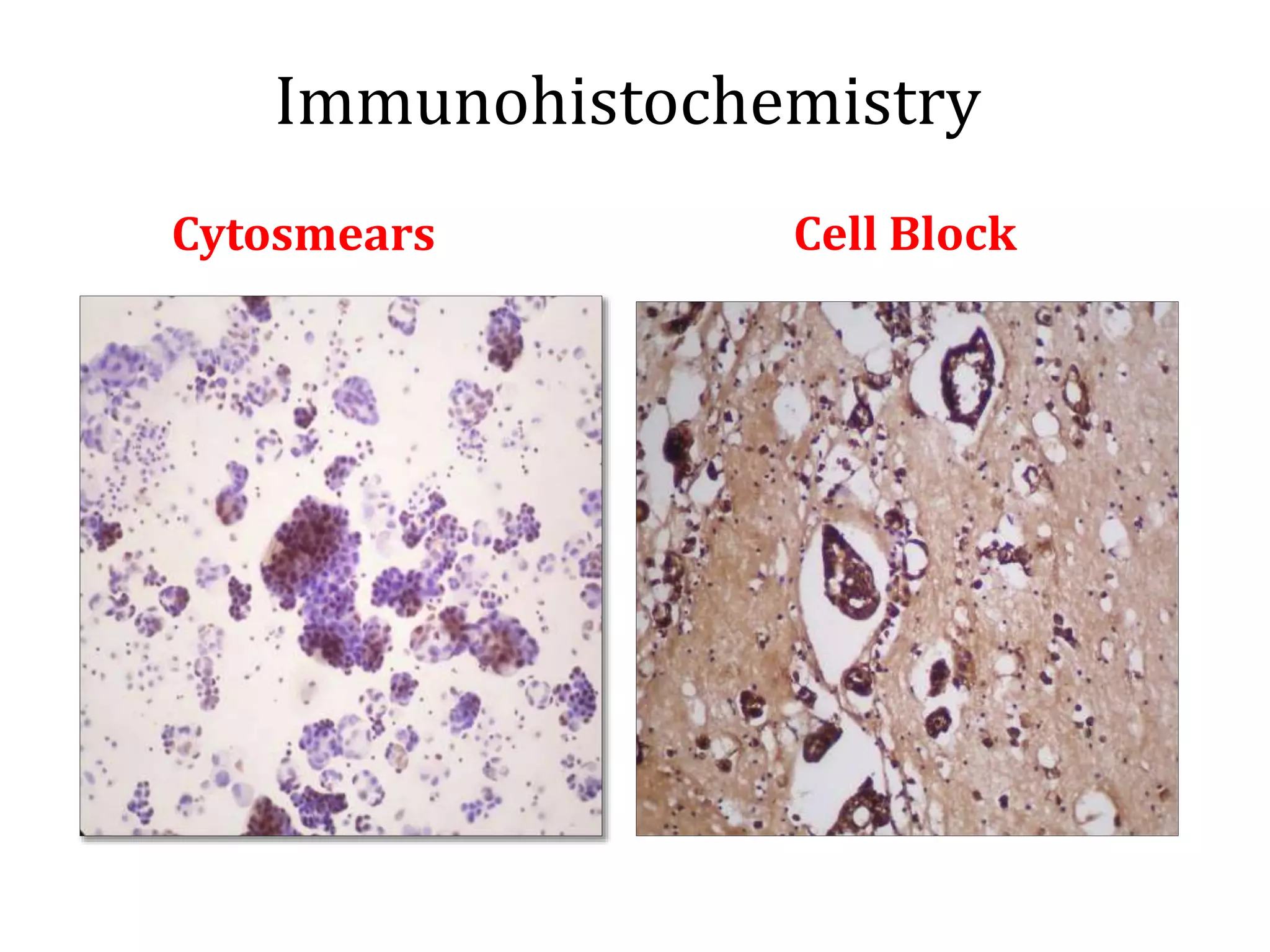 Cytosmears Cell Block
Immunohistochemistry
 