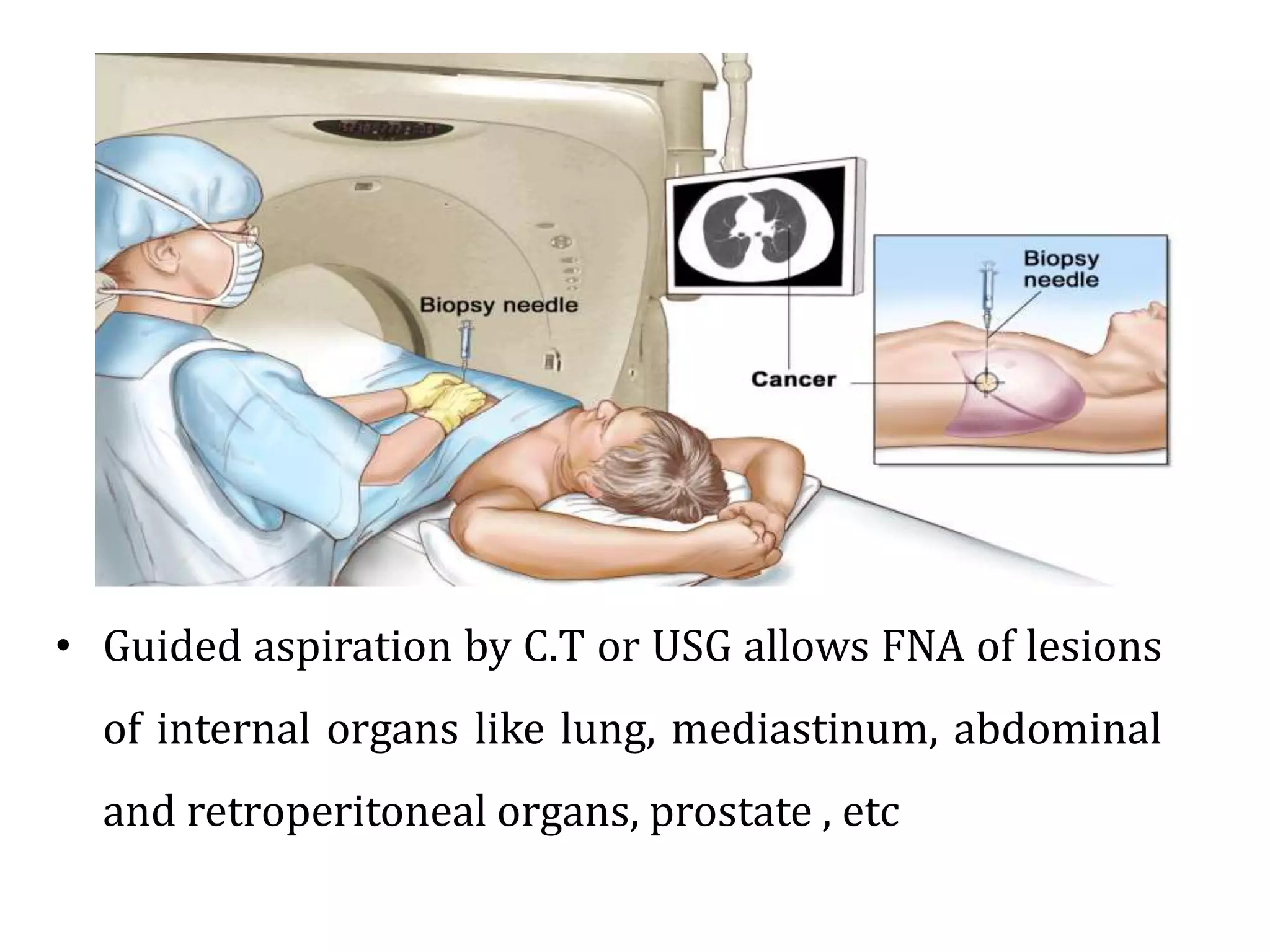 • Guided aspiration by C.T or USG allows FNA of lesions
of internal organs like lung, mediastinum, abdominal
and retroperitoneal organs, prostate , etc
 