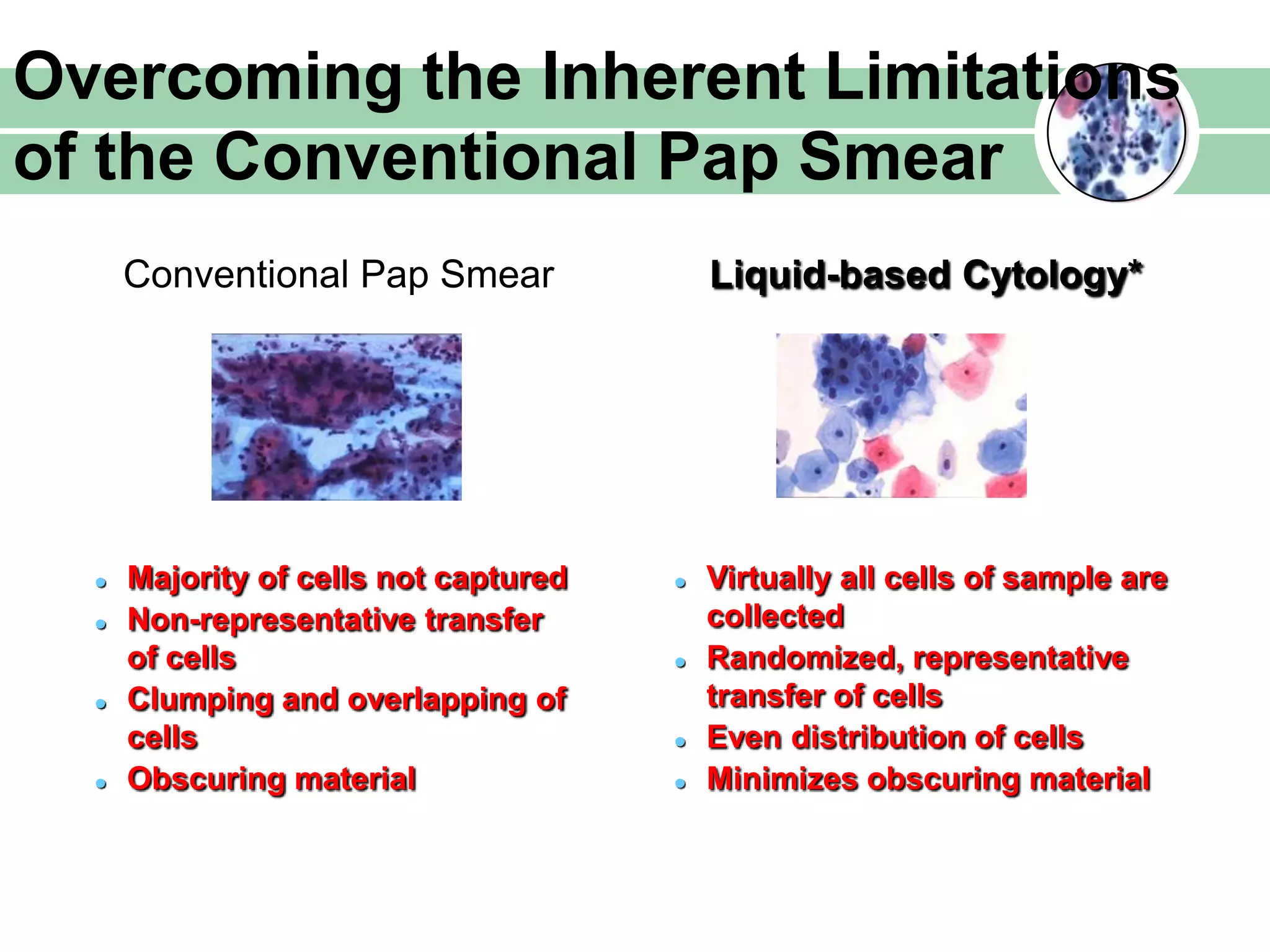 Conventional Pap Smear
Overcoming the Inherent Limitations
of the Conventional Pap Smear
 Majority of cells not captured
 Non-representative transfer
of cells
 Clumping and overlapping of
cells
 Obscuring material
 Virtually all cells of sample are
collected
 Randomized, representative
transfer of cells
 Even distribution of cells
 Minimizes obscuring material
Liquid-based Cytology*
 