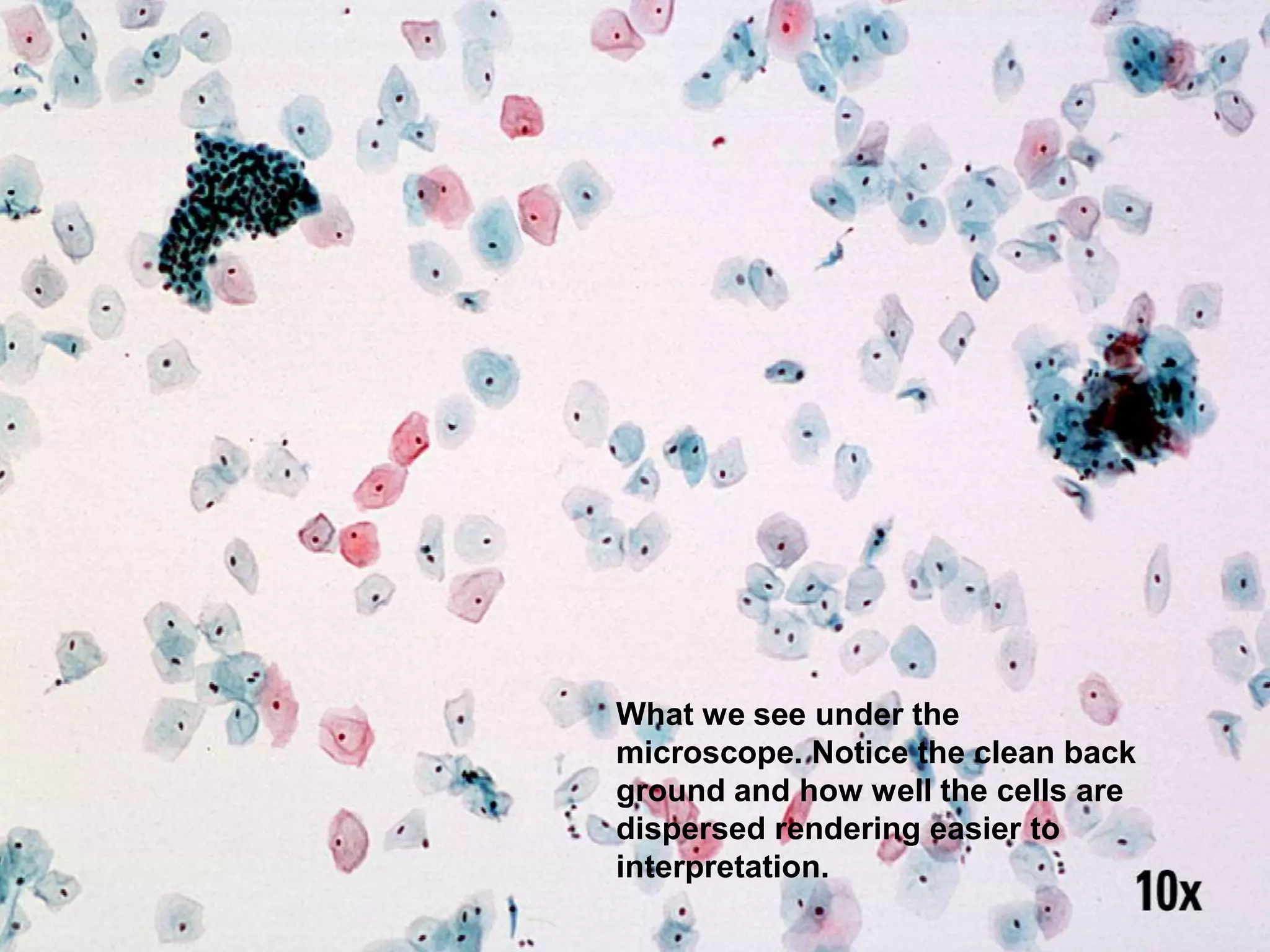 What we see under the
microscope. Notice the clean back
ground and how well the cells are
dispersed rendering easier to
interpretation.
 
