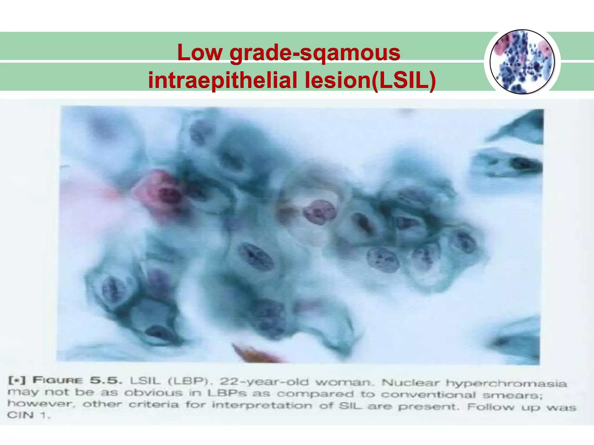 Low grade-sqamous
intraepithelial lesion(LSIL)
 