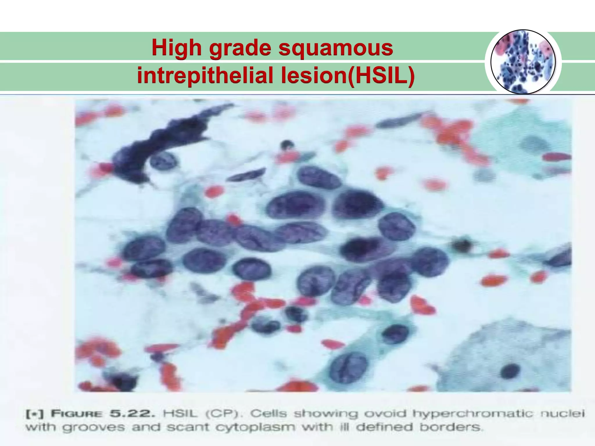 High grade squamous
intrepithelial lesion(HSIL)
 