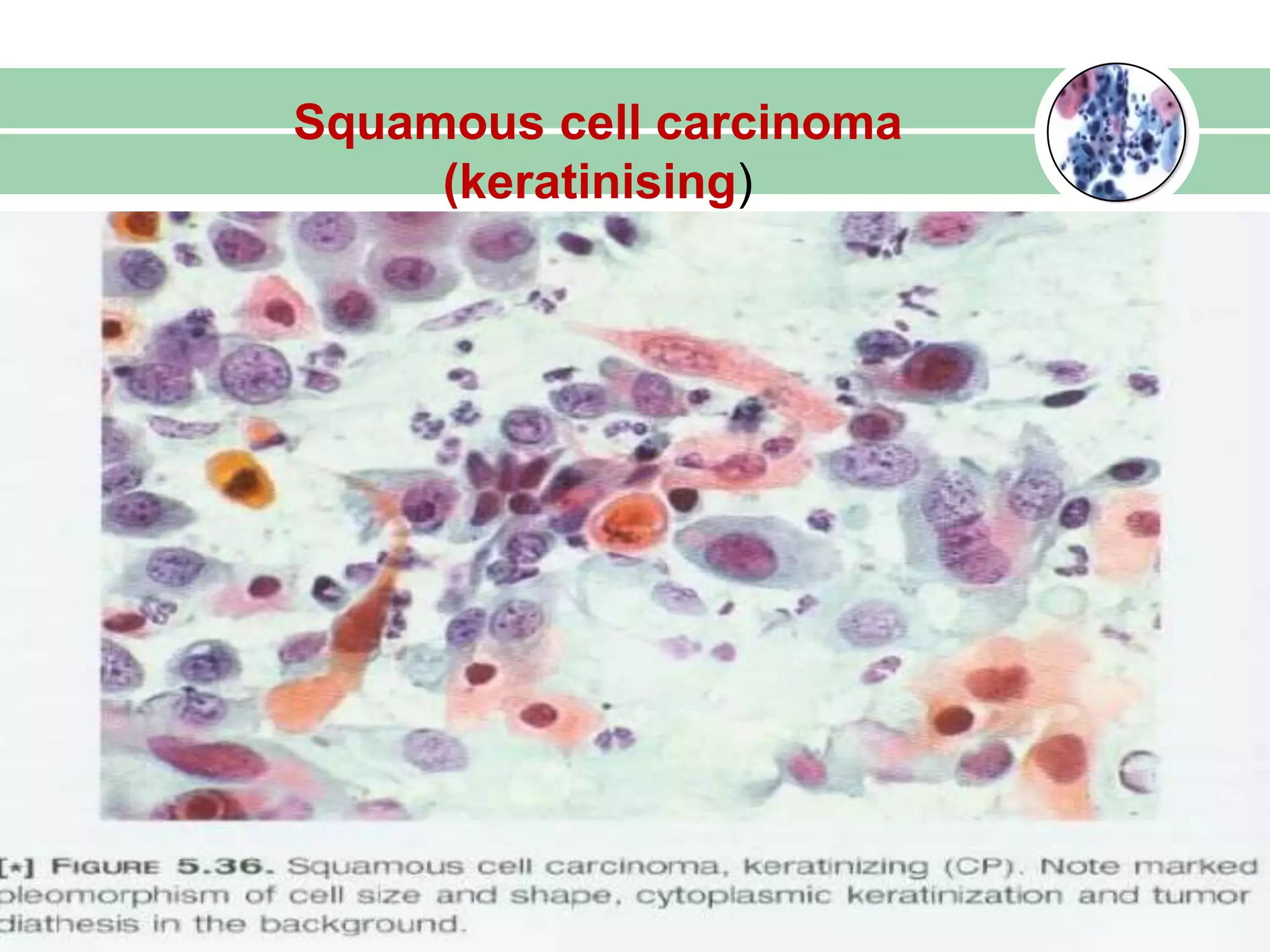 Squamous cell carcinoma
(keratinising)
 