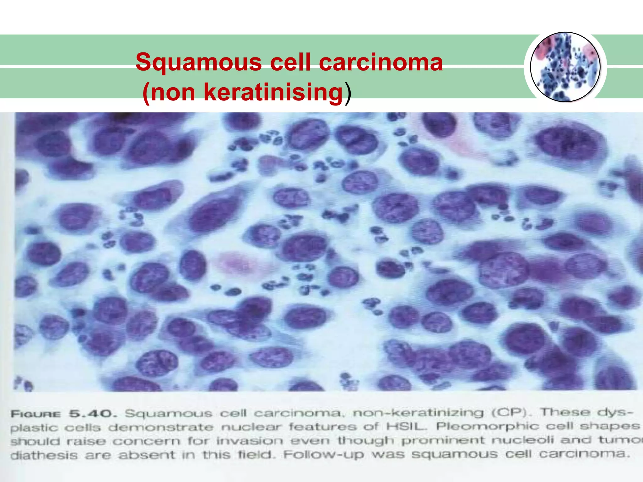 Squamous cell carcinoma
(non keratinising)
 