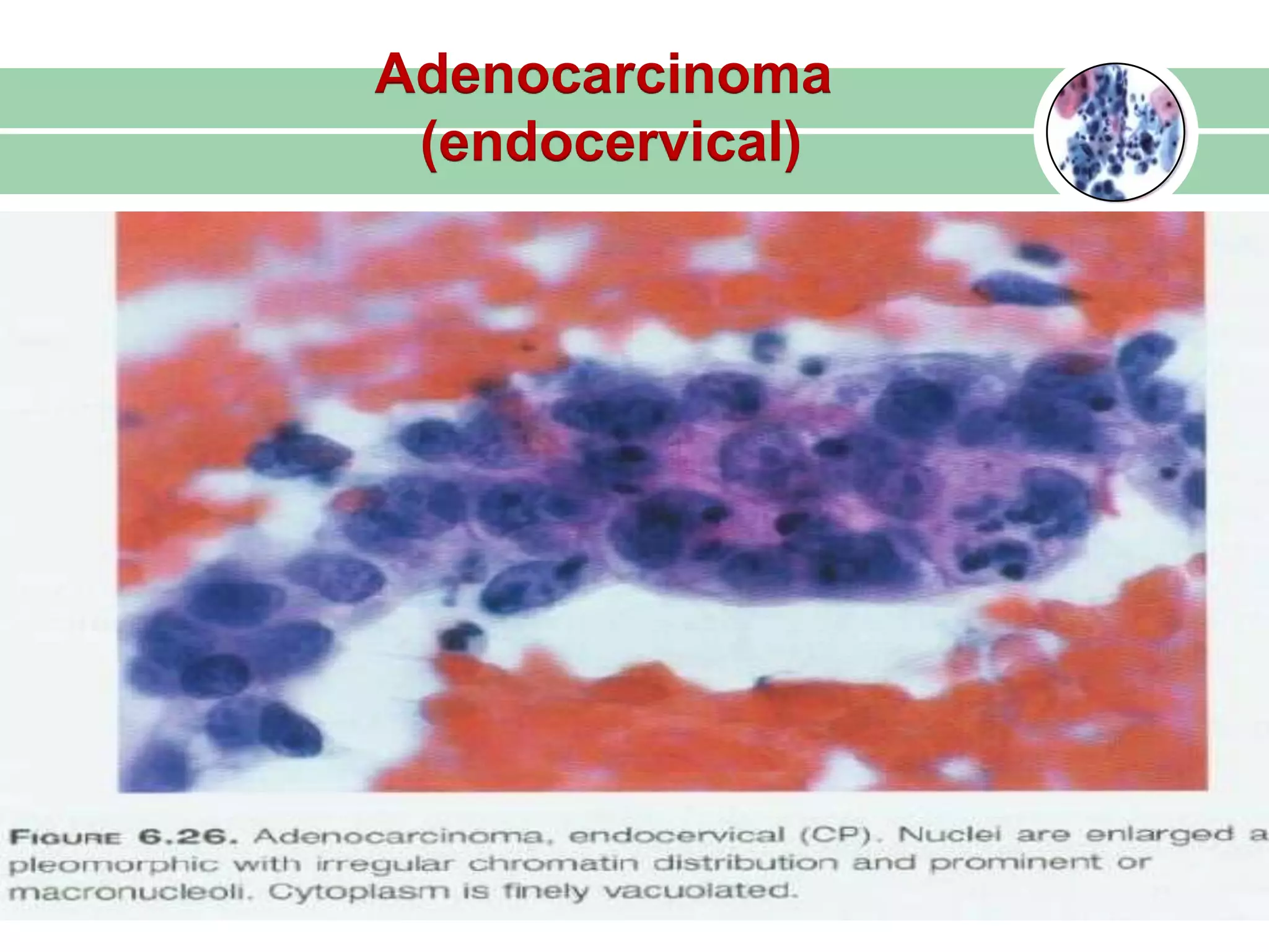 Adenocarcinoma
(endocervical)
 