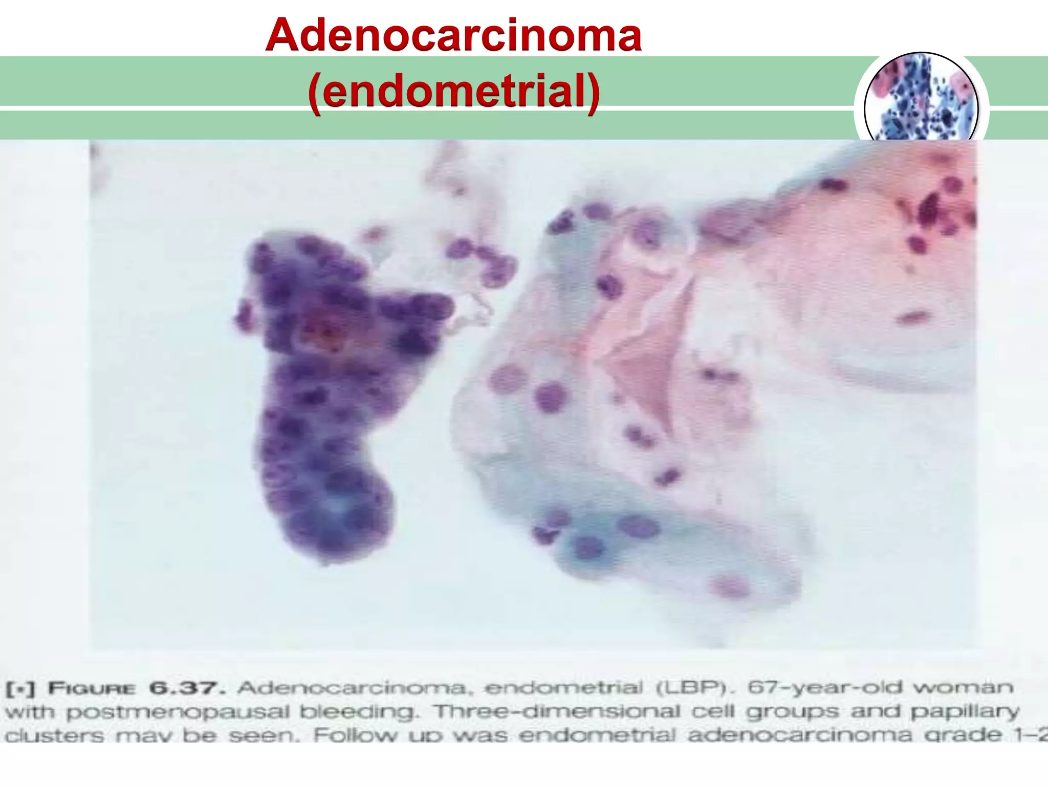 Adenocarcinoma
(endometrial)
 