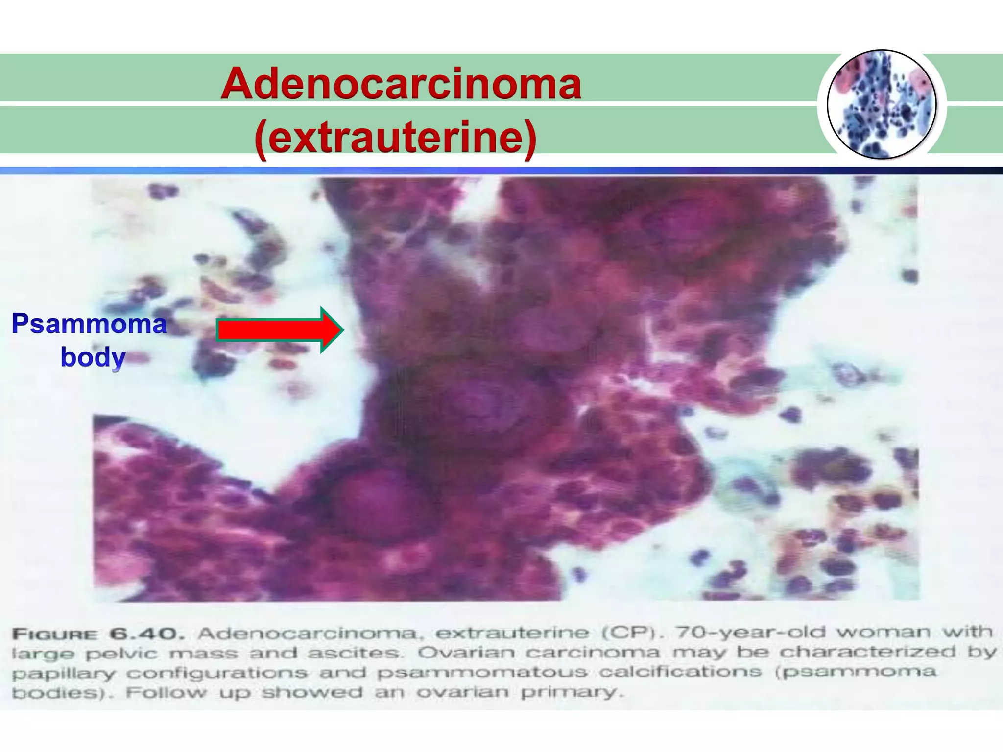 Adenocarcinoma
(extrauterine)
 