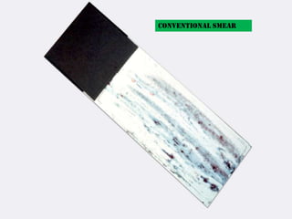 Conventional smear
 