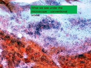 What we see under the
microscope conventional
smear
 