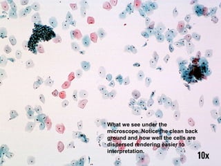 What we see under the
microscope. Notice the clean back
ground and how well the cells are
dispersed rendering easier to
interpretation.
 