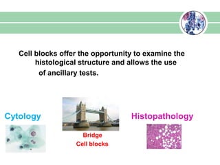 Cell blocks offer the opportunity to examine the
histological structure and allows the use
of ancillary tests.
Cytology Histopathology
Bridge
Cell blocks
 