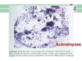 Actinomyces
 