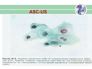 ASC-US
 