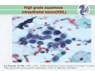 High grade squamous
intrepithelial lesion(HSIL)
 