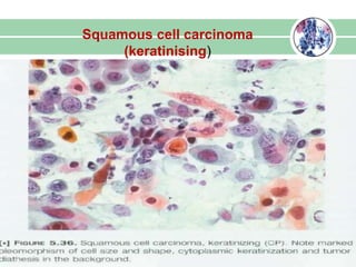Squamous cell carcinoma
(keratinising)
 
