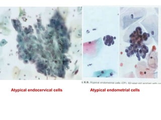 Atypical endocervical cells Atypical endometrial cells
 