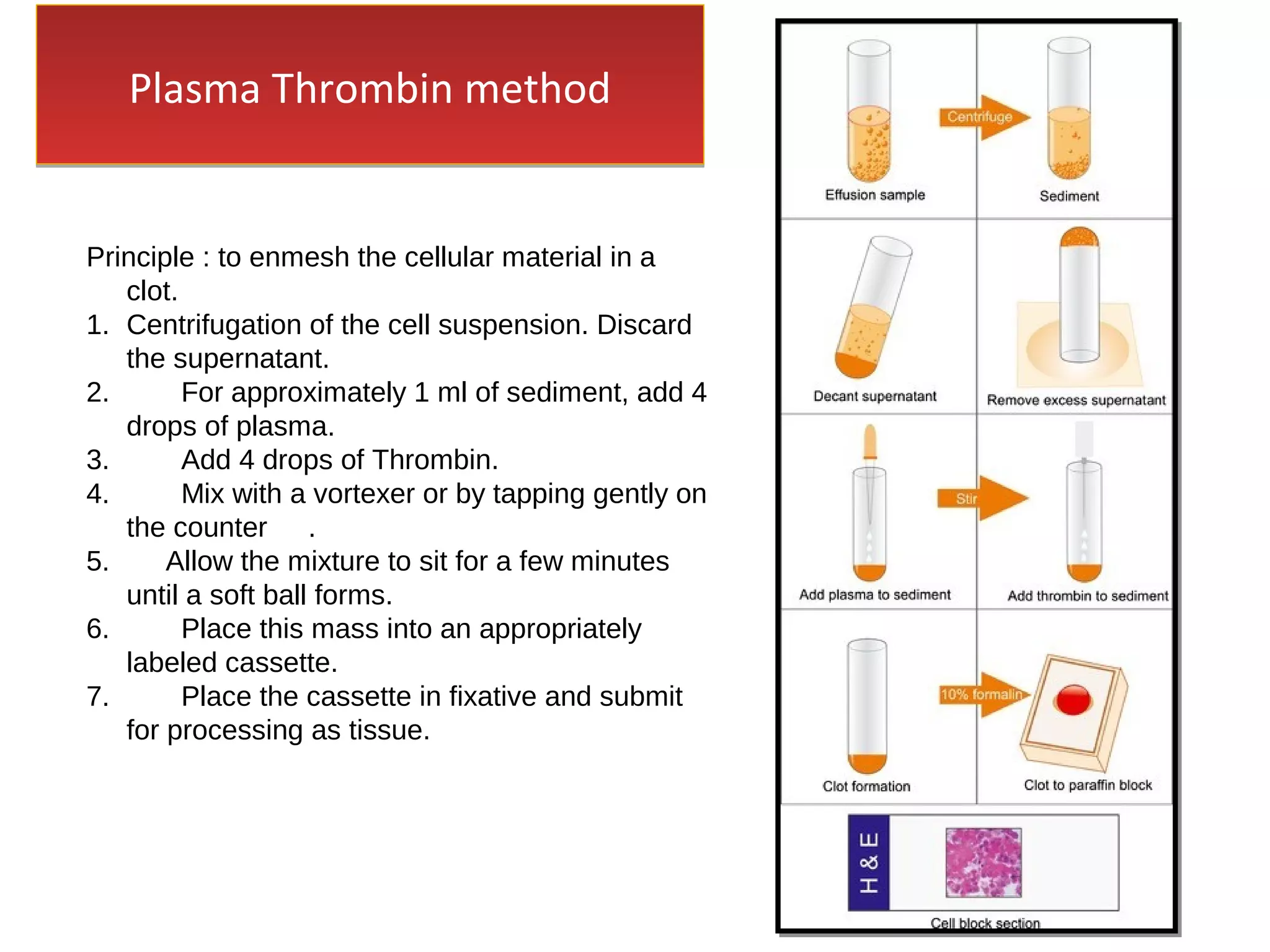 Plasma Thrombin methodPlasma Thrombin method
Principle : to enmesh the cellular material in a
clot.
1. Centrifugation of the cell suspension. Discard
the supernatant.
2. For approximately 1 ml of sediment, add 4
drops of plasma.
3. Add 4 drops of Thrombin.
4. Mix with a vortexer or by tapping gently on
the counter .
5. Allow the mixture to sit for a few minutes
until a soft ball forms.
6. Place this mass into an appropriately
labeled cassette.
7. Place the cassette in fixative and submit
for processing as tissue.
 