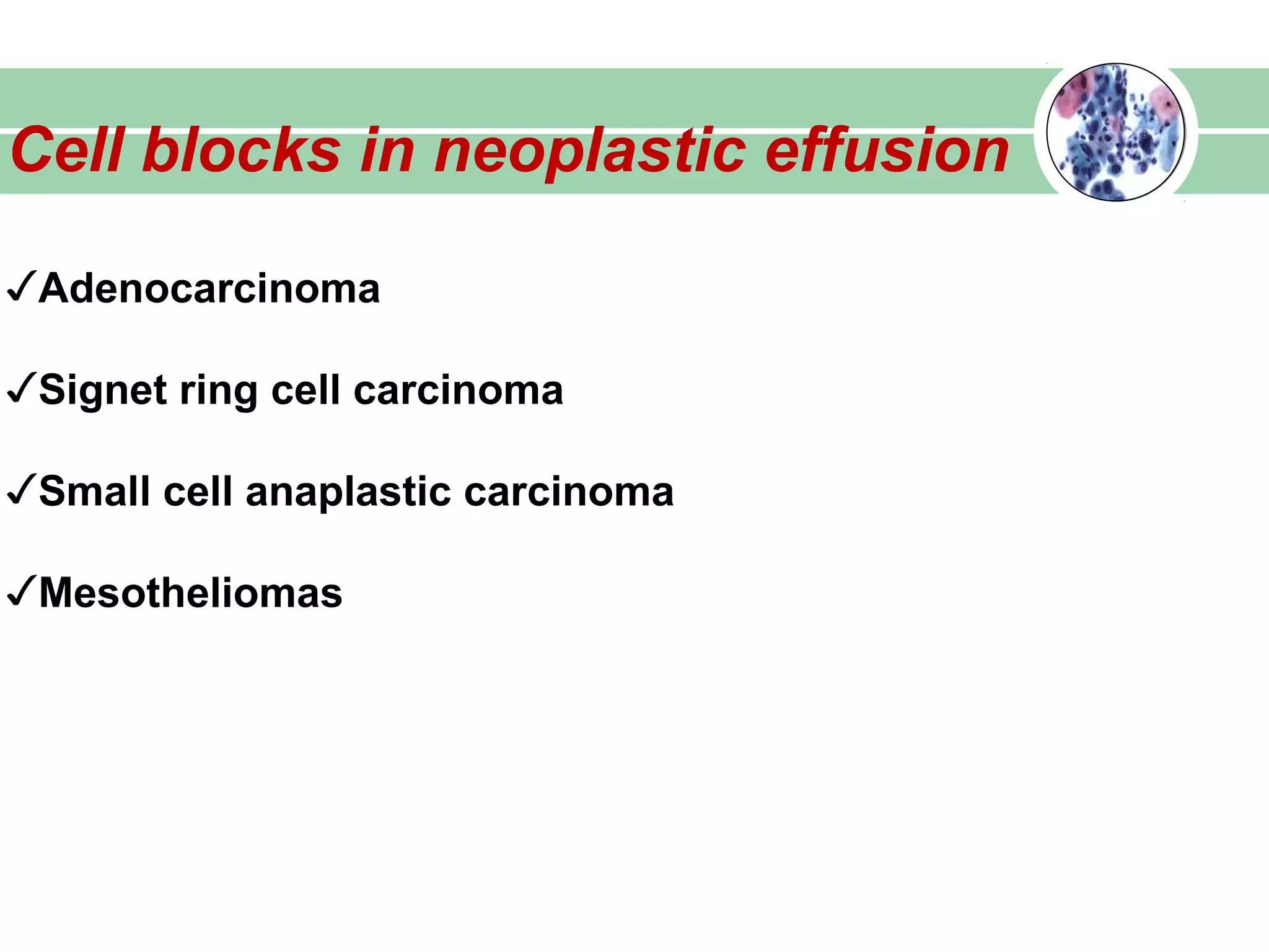Cell blocks in neoplastic effusion
✓Adenocarcinoma
✓Signet ring cell carcinoma
✓Small cell anaplastic carcinoma
✓Mesotheliomas
 