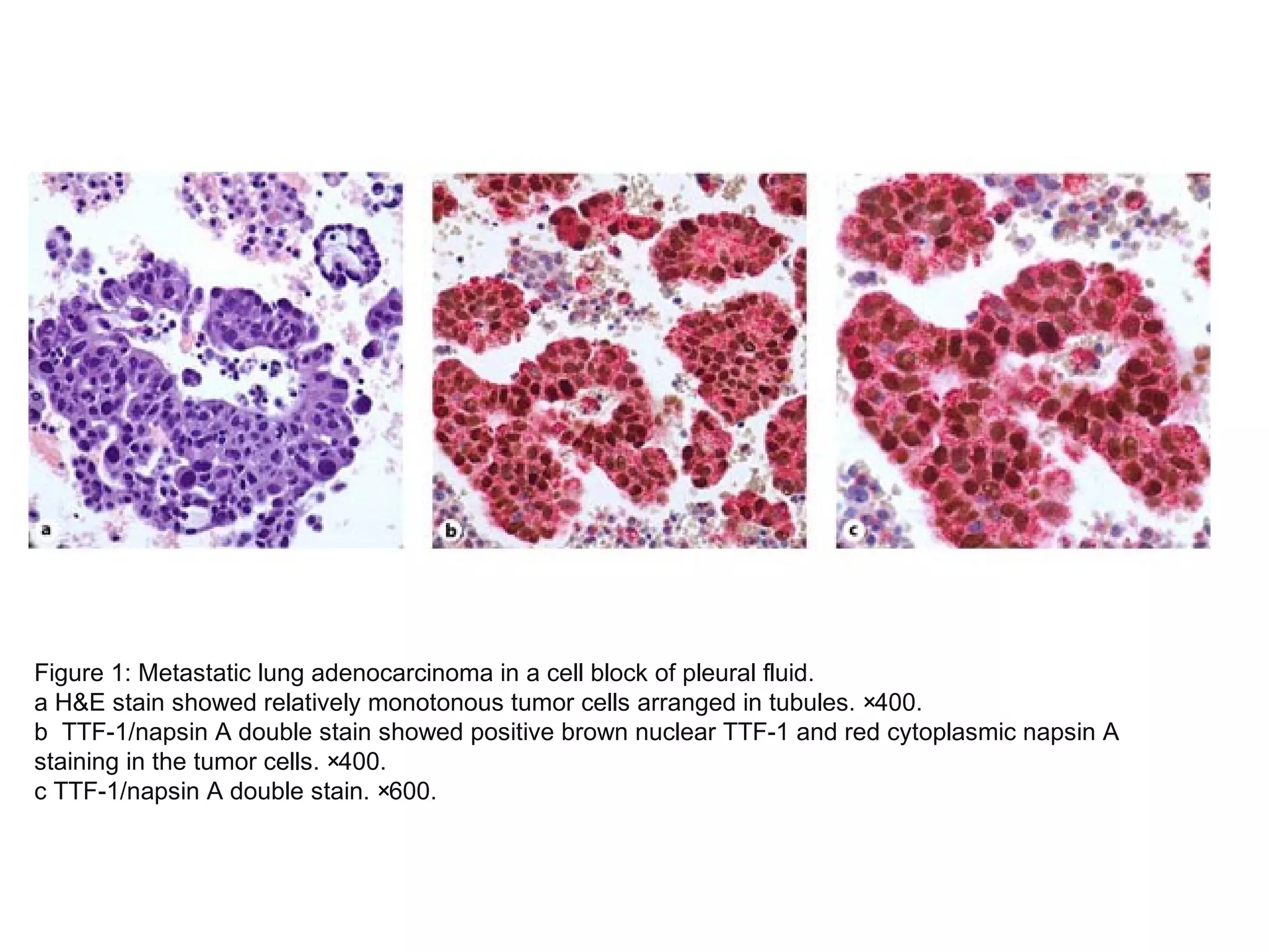 Figure 1: Metastatic lung adenocarcinoma in a cell block of pleural fluid.
a H&E stain showed relatively monotonous tumor cells arranged in tubules. ×400.
b TTF-1/napsin A double stain showed positive brown nuclear TTF-1 and red cytoplasmic napsin A
staining in the tumor cells. ×400.
c TTF-1/napsin A double stain. ×600.
 