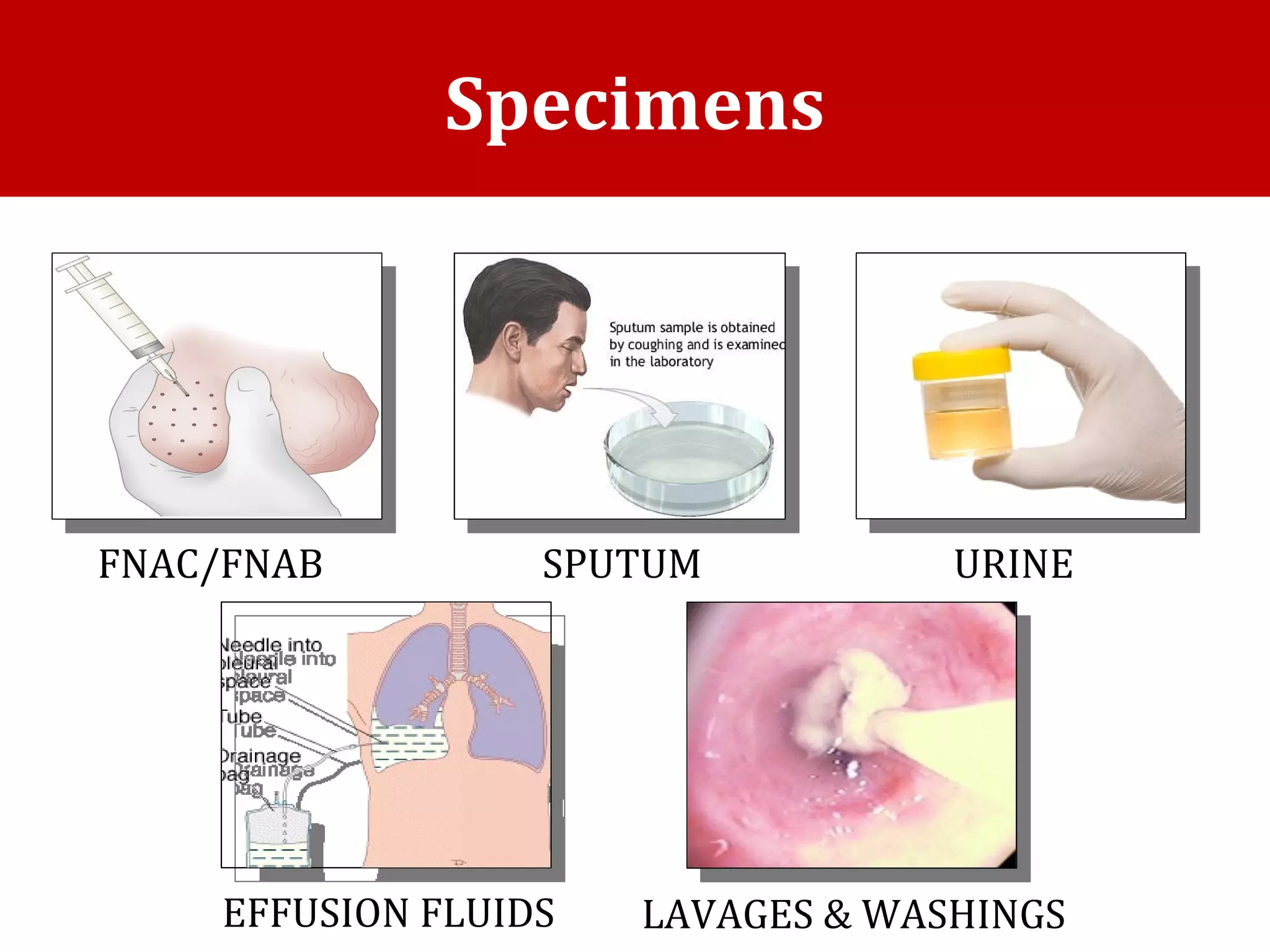 Specimens
FNAC/FNAB SPUTUM
EFFUSION FLUIDS
URINE
LAVAGES & WASHINGS
 