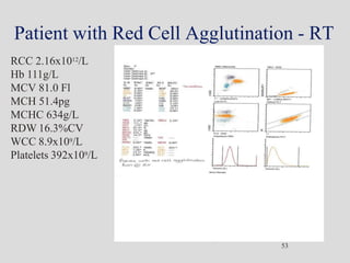 Patient with Red Cell Agglutination - RT
RCC 2.16x1012/L
Hb 111g/L
MCV 81.0 Fl
MCH 51.4pg
MCHC 634g/L
RDW 16.3%CV
WCC 8.9x109/L
Platelets 392x109/L
53
 