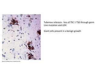 Tuberous sclerosis: loss of TSC 1 TSG through germ
Line mutation and LOH
Giant cells present in a benign growth
 