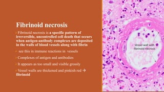 Fibrinoid necrosis
Fibrinoid necrosis is a specific pattern of
irreversible, uncontrolled cell death that occurs
when ant...