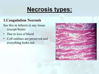 Necrosis types:
1.Coagulation Necrosis
See this in infarcts in any tissue
(except brain)
• Due to loss of blood
• Cell outlines are preserved and
everything looks red.
 