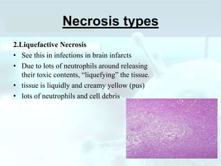 Necrosis types
2.Liquefactive Necrosis
• See this in infections in brain infarcts
• Due to lots of neutrophils around releasing
their toxic contents, “liquefying” the tissue.
• tissue is liquidly and creamy yellow (pus)
• lots of neutrophils and cell debris
 