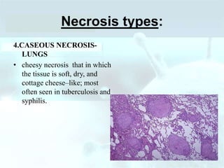Necrosis types:
4.CASEOUS NECROSIS-
LUNGS
• cheesy necrosis that in which
the tissue is soft, dry, and
cottage cheese–like; most
often seen in tuberculosis and
syphilis.
 