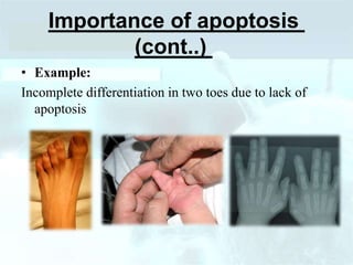 Importance of apoptosis
(cont..)
• Example:
Incomplete differentiation in two toes due to lack of
apoptosis
 