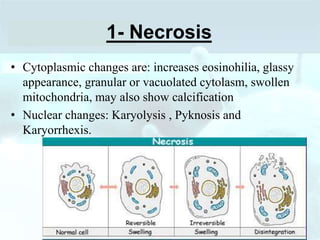 1- Necrosis
• Cytoplasmic changes are: increases eosinohilia, glassy
appearance, granular or vacuolated cytolasm, swollen
mitochondria, may also show calcification
• Nuclear changes: Karyolysis , Pyknosis and
Karyorrhexis.
 