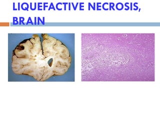 LIQUEFACTIVE NECROSIS,
BRAIN
 