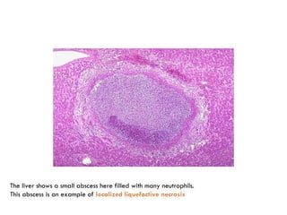 The liver shows a small abscess here filled with many neutrophils.
This abscess is an example of localized liquefactive necrosis
 