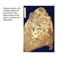 Caseous necrosis, with
confluent cheesy tan
granulomas in the
upper portion of this
lung in a patient with
tuberculosis.
 